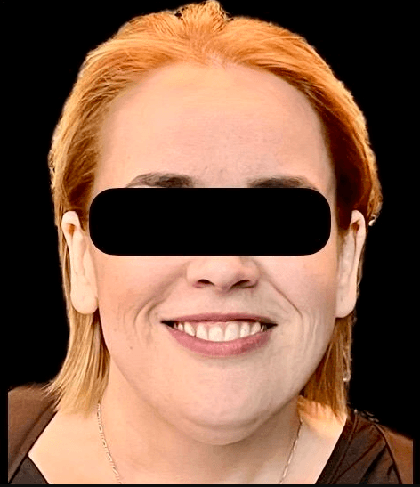 Sonrisa antes del tratamiento de carillas